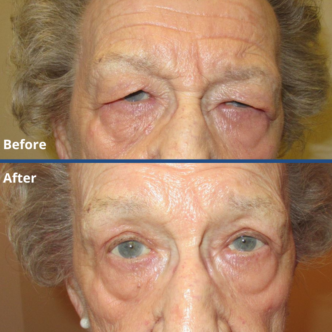 Oculoplastics Surgery Minneapolis